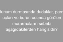 Solunum durmasında dudaklar, parmak uçları ve burun ucunda görülen morarmaların sebebi aşağıdakilerden hangisidir?